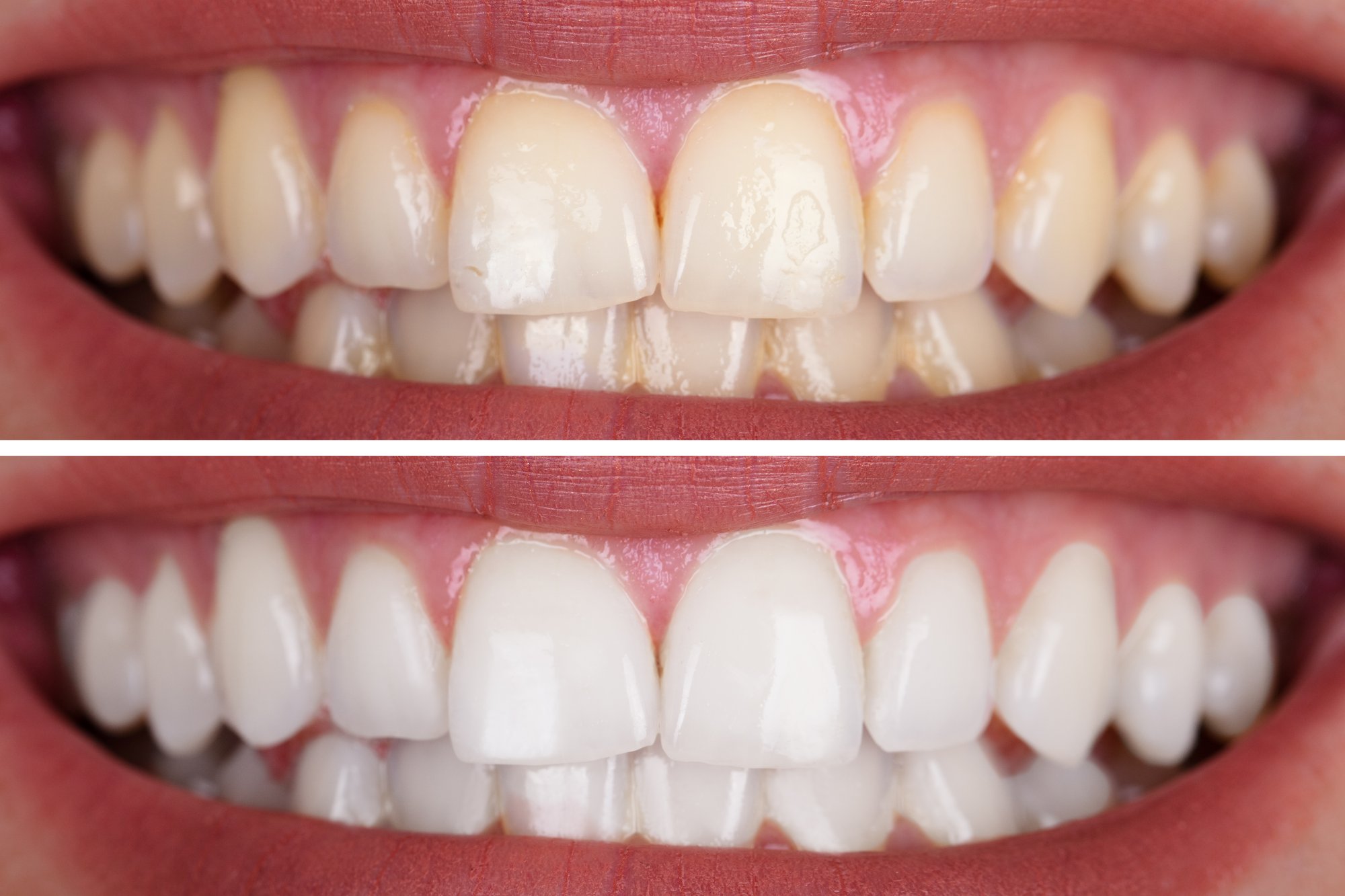 What Causes Teeth to Turn Yellow?